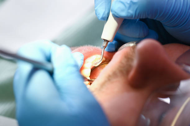 Best Emergency Wisdom Teeth Removal in Richmond, KY