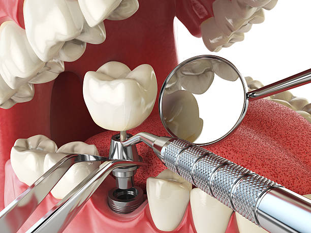 Best Emergency Denture Repair in Richmond, KY